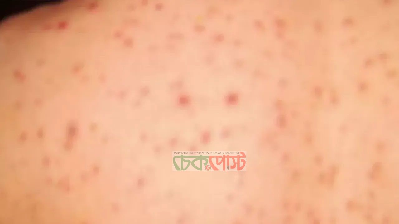 গাইবান্ধায় গুটি বসন্তে শিক্ষকের মৃত্যু, একই পরিবারের ৩ জন আক্রান্ত