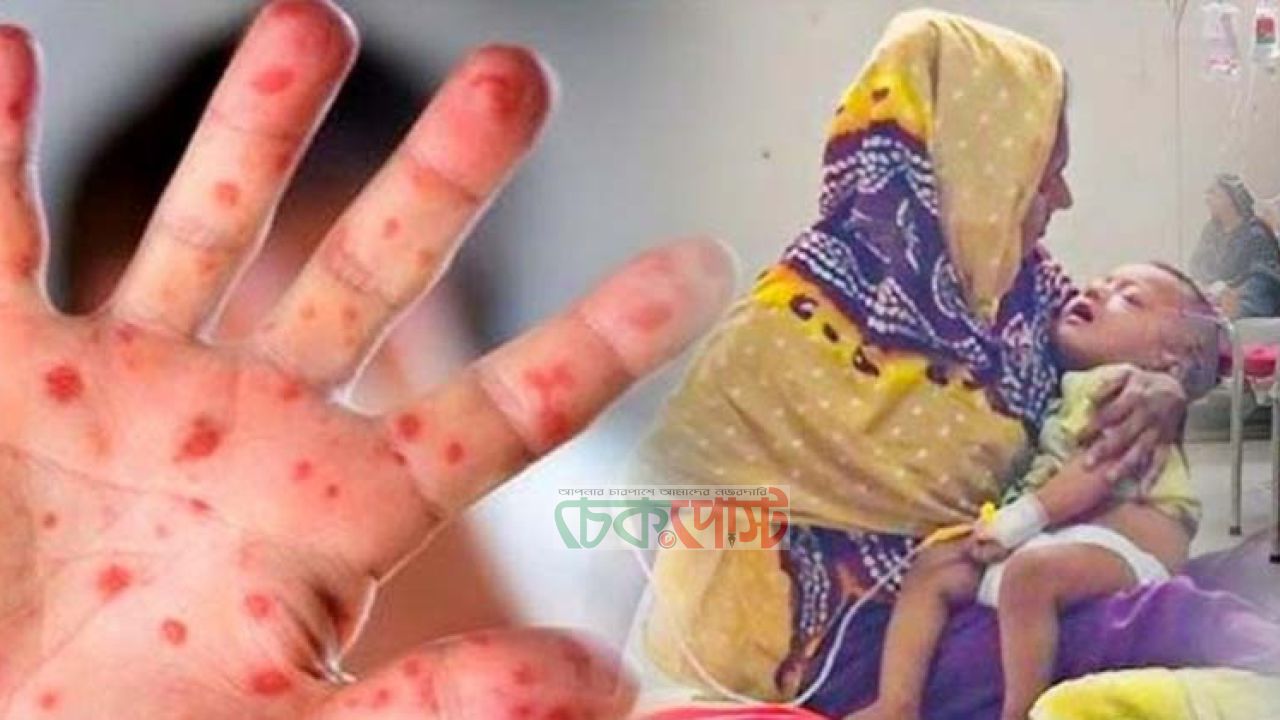 হাম আতঙ্কে দেশ, ২৪ ঘণ্টায় ১০ শিশুর মৃত্যু দেশজুড়ে দ্রুত ছড়াচ্ছে হাম সংক্রমণ