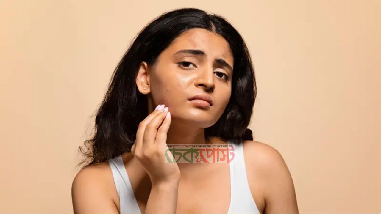 ব্রেকআপের পর ব্রণ কেন বাড়ে? মানসিক চাপেই কি ত্বকের সমস্যা জেনে নিন