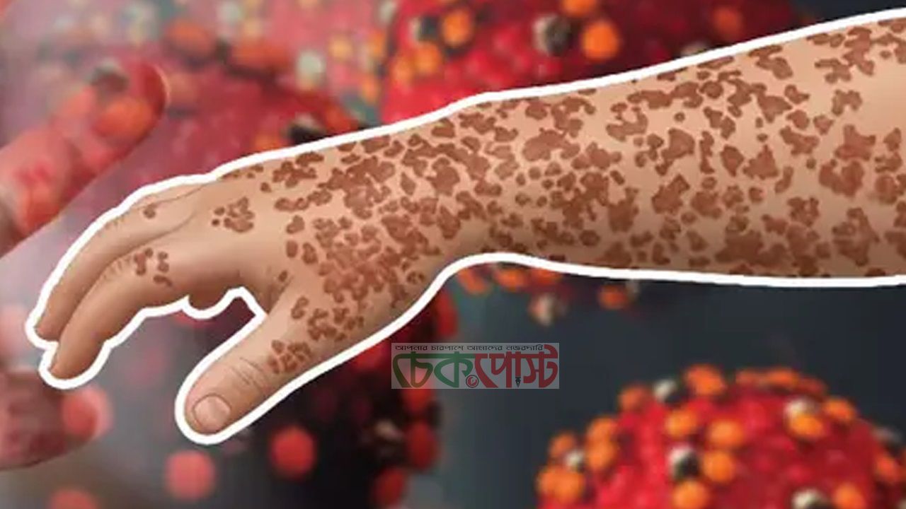 সিলেটে হাম পরিস্থিতি উদ্বেগজনক, একদিনে ৩ শিশুর প্রাণহানি