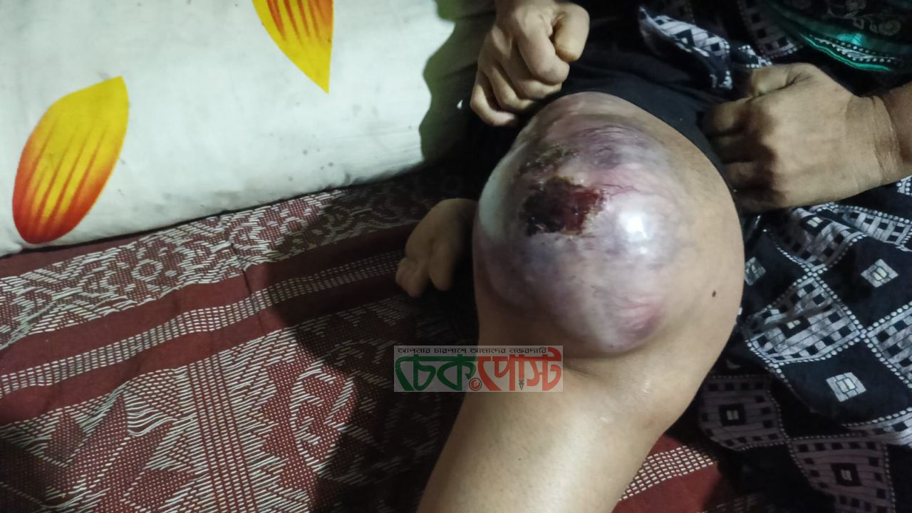 মাধবপুরে ক্যান্সার চিকিৎসার নামে অর্থ নেওয়ার অভিযোগ, পাঁচ মাস পর পা কাটার পরামর্শ