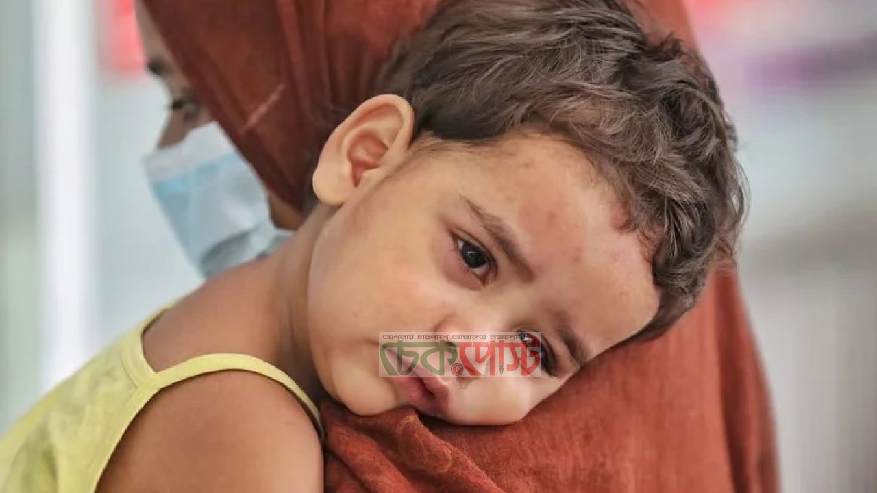 হামের উপসর্গে আরও ২ শিশুর মৃত্যু, আক্রান্ত ১,২৯৭